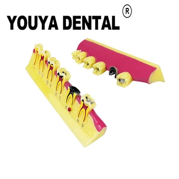Dentes Modelo de Ensino 2 Vezes a Doença Periodontal, Desenvolver um Modelo Com a Cárie Dental Técnico de Formação Estudar Modelos